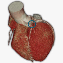 herz-ct-01
